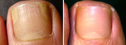 Ящик Пандори - як лікують грибок нігтів лазером переваги лазерної терапії