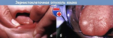 Zernistokletochnaya tumor (daganat zernistokletochnaya) Zernistokletochnaya tumor