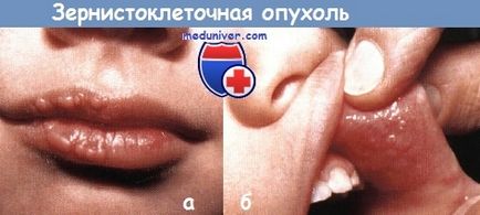 Zernistokletochnaya tumor (daganat) Zernistokletochnaya tumor