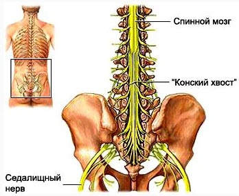 Neoplasm malign al cozii ponei a semnelor de maduva spinarii, tratament, complicatii