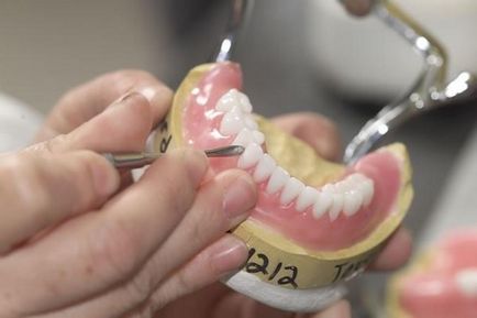 Proteze dentare din nailon în stomatologie, clinica vegastom
