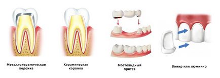 Зубні протези в Сімферополі, ціна в клініці, стоматологія дентаплюс сімферополь