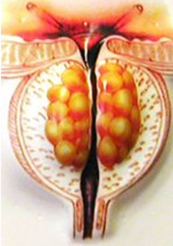 Adenomul prostatei