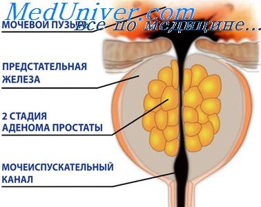 Adenomul prostatei