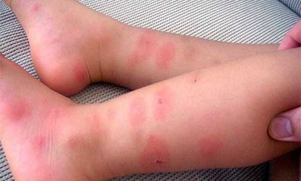 Алергія на комарів - у дитини і у дорослого