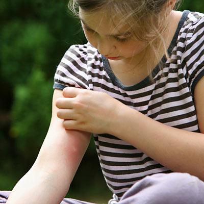 Alergie la țânțari - la un copil și la un adult