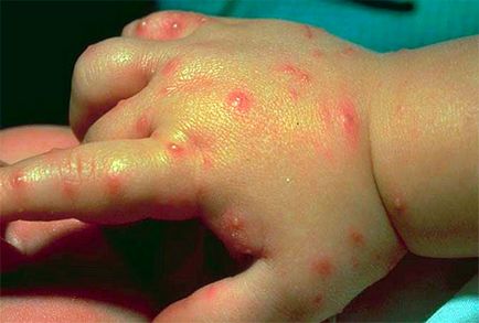 Alergie la țânțari - la un copil și la un adult