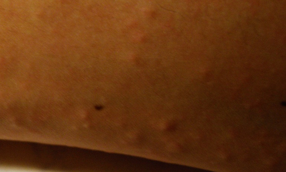 Алергія на укуси комарів фото, причини, лікування, стоп алергія