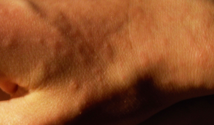 Allergiás a harapás szúnyogok fotó, okok, kezelés, abba allergia