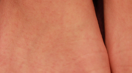 Allergiás a harapás szúnyogok fotó, okok, kezelés, abba allergia