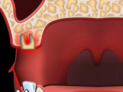 Alveolita tratament fântâni