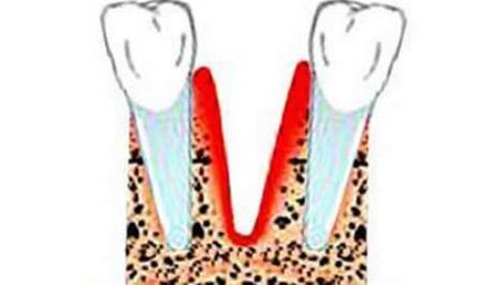 Альвеолит після видалення зуба - симптоми і лікування