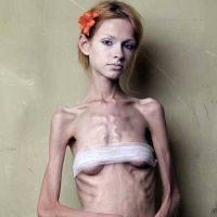 Anorexia la copii
