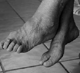 Artroza simptomelor și tratamentului la picioare, fotografie a artrozei