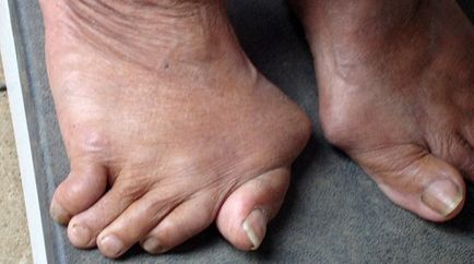 Artroza simptomelor și tratamentului la picioare, fotografie a artrozei