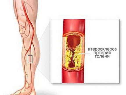 Ateroscleroza obliterând cauzele, simptomele, tratamentul obliteranelor de ateroscleroză