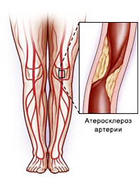 Arteriosclerosis obliterans okoz, a tünetek, a kezelés az atherosclerosis obliterans