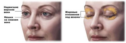 Blefaroplastia sau plasticul secolului