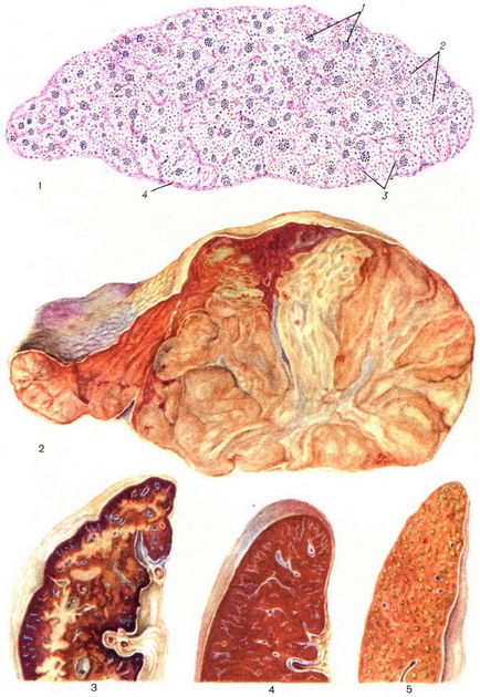 Rătăcirea splinei infarctului de abces echinococcus chisturi hipersplenism tumori