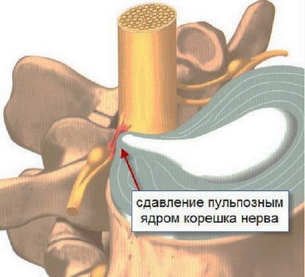 Hasi fájdalom osteochondrosis, adhat az alsó, okozhat duzzanatot és égő