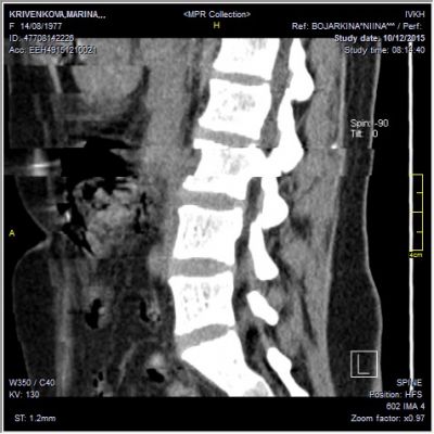 Біль у спині - причини, симптоми, лікування - лікування в клініці доктора Ігнатьєва г