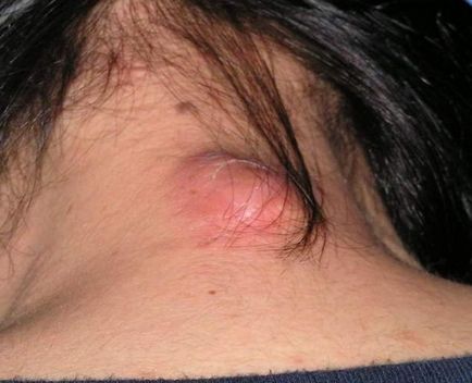 Mi az atheroma (a) Mi atheroma