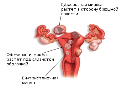 Care este miomul interstițial-subseros al uterului