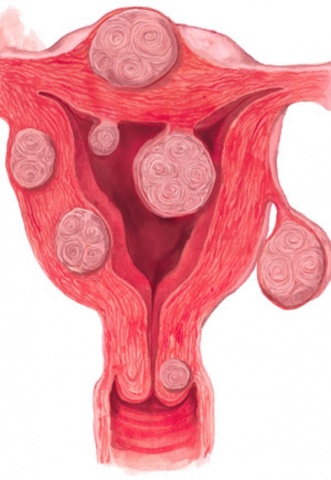 Care este miomul interstițial-subseros al uterului