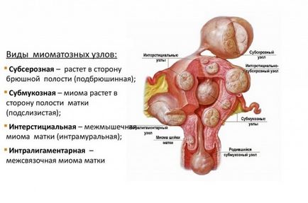 Care este miomul interstițial-subseros al uterului