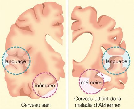 Demența la vârstnici, simptome, semne, etape de dezvoltare, prognostic, speranța de viață