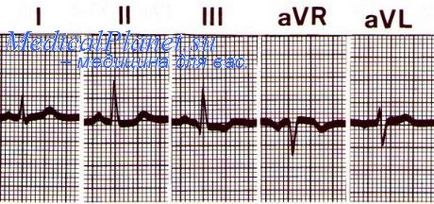 Depresia segmentului st cu infarct miocardic