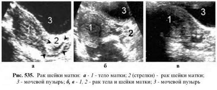 Діагностика раку матки - узі