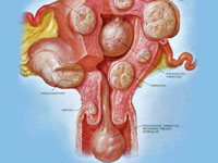 Dieta cu miom uterin (nutriție) - meniu, recenzii, după îndepărtare