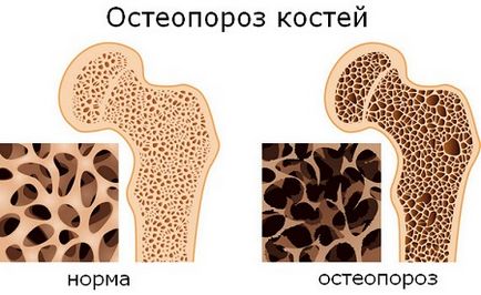 Дієта при остеопорозі лікувальне харчування і меню при остеопорозі хребта