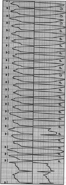 Diagnosticul diferențial al tahiaritmiilor conform ECG