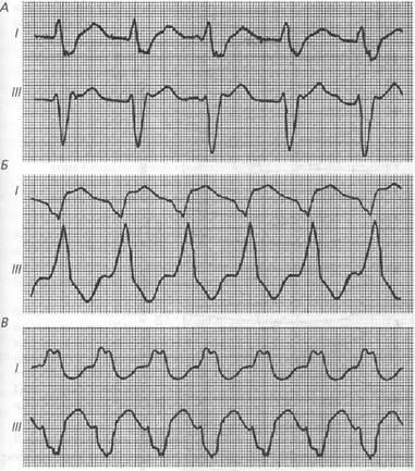 Differenciáldiagnosztikája ritmuszavar EKG