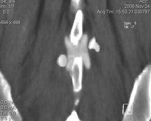 Stabilizarea dinamică a coloanei vertebrale (instalarea implanturilor interstițiale) - neurochirurgical