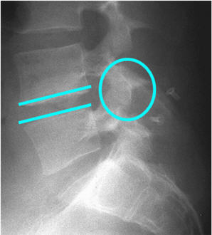 Stabilizarea dinamică a coloanei vertebrale (instalarea implanturilor interstițiale) - neurochirurgical