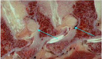 Stabilizarea dinamică a coloanei vertebrale (instalarea implanturilor interstițiale) - neurochirurgical