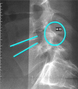 Stabilizarea dinamică a coloanei vertebrale (instalarea implanturilor interstițiale) - neurochirurgical