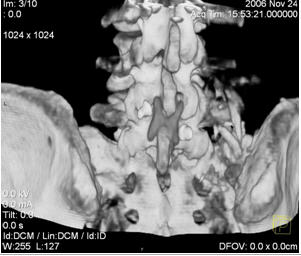 Stabilizarea dinamică a coloanei vertebrale (instalarea implanturilor interstițiale) - neurochirurgical