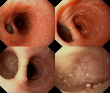 Dysphagia okok, tünetek, mértékét, a kezelés a szindróma, különösen gyermekek esetében, a funkcionális dysphagia