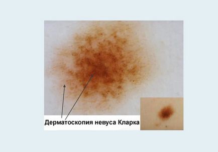 Dizplastic nevus clarke cauze, simptome, tratament, eliminare, fotografie