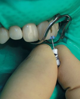 A endodonciás eszköze gyökérkezelés kézikönyv