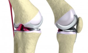 Endoprosthetica articulațiilor o șansă de mișcare