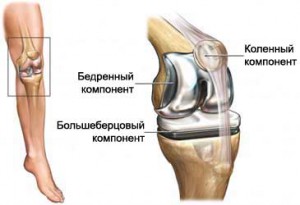 Ендопротезування суглобів шанс на рухи