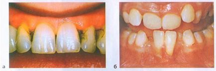Etiologia și patogeneza bolii parodontale