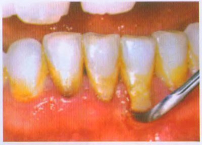 A etiológiája és patogenezise periodontális betegségek