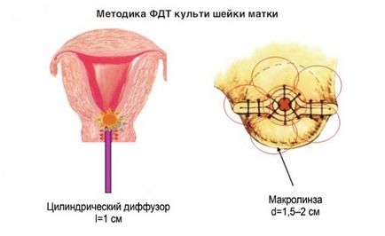 Фотодинамічна терапія шийки матки - високоефективний метод