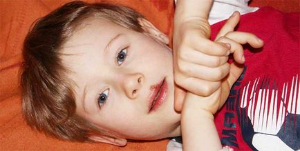 Герпес на губі у дитини причини, лікування, симптоми (фото)